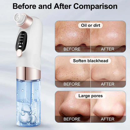 Blackhead Suction Remover Vacuum Pore Cleaner. Electric facial tool for deep cleaning blackheads & unclogging pores. Waterproof.