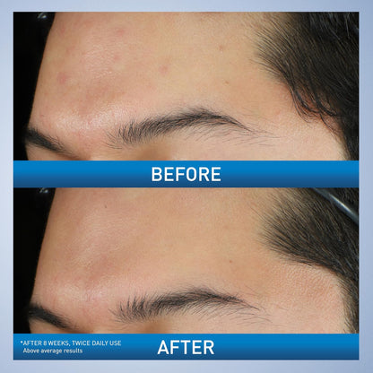 CeraVe Acne Foaming Cream Wash with 10% Benzoyl Peroxide. Treats breakouts on face & body, gentle with Niacinamide & Hyaluronic Acid.