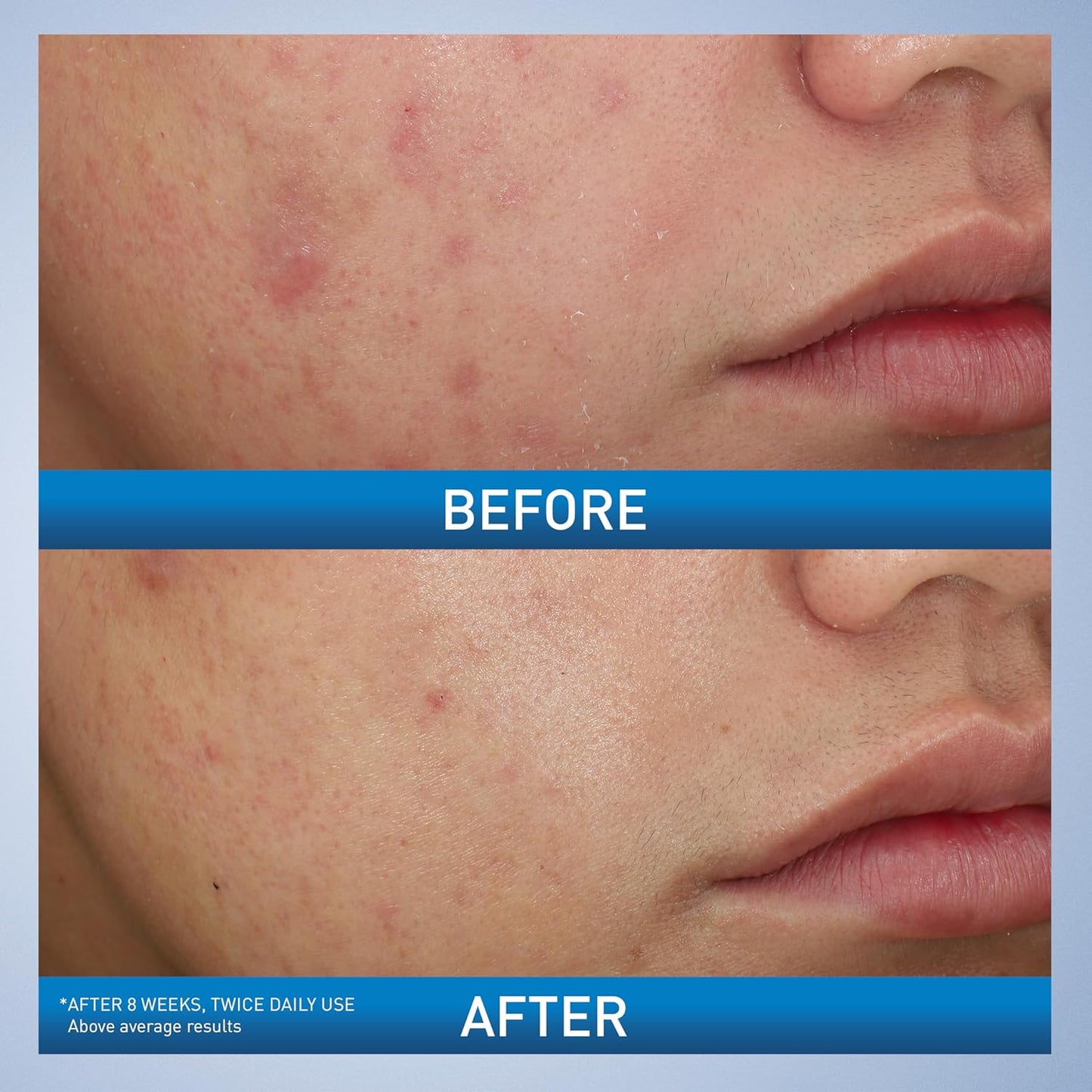 CeraVe Acne Foaming Cream Wash with 10% Benzoyl Peroxide. Treats breakouts on face & body, gentle with Niacinamide & Hyaluronic Acid.